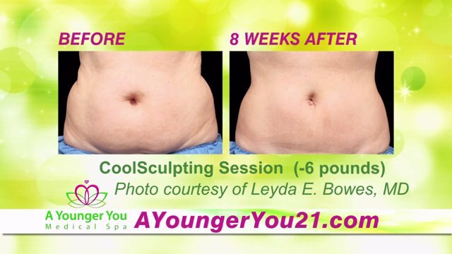 FOX Focus: Learn all about Cool Sculpting offered by A Younger You