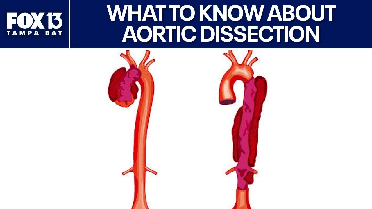 What to know about Aortic Dissection