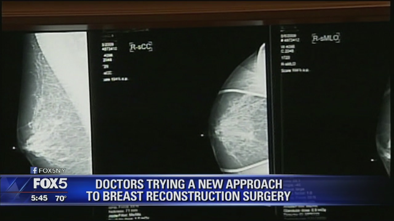 Breast-reconstruction surgery options