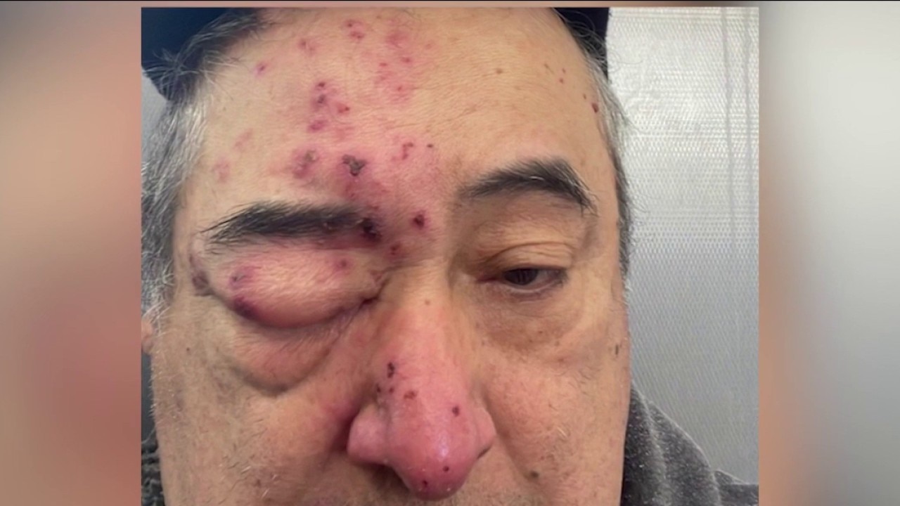 Rats bite sleeping Rogers Park apartment tenant's face