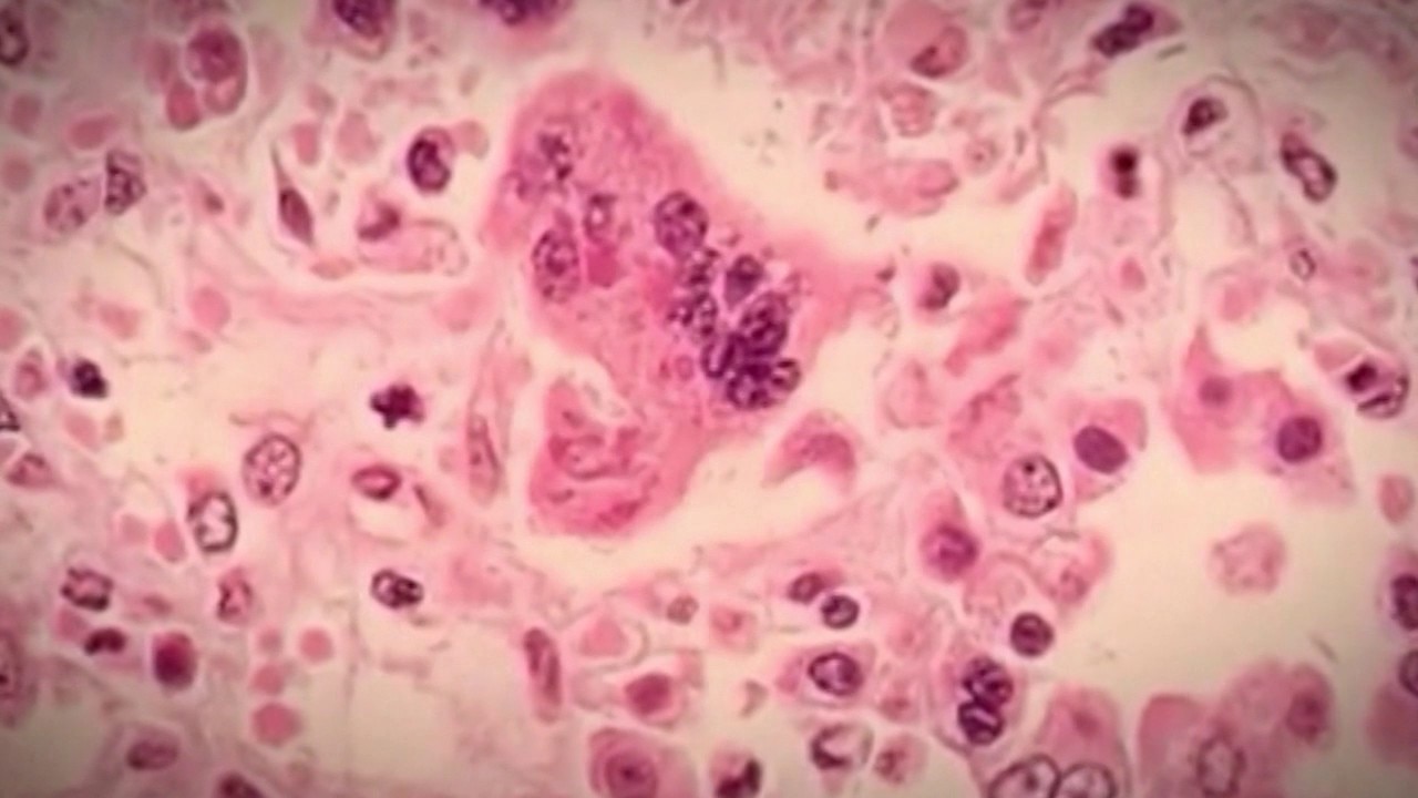 Georgia measles cases rise after daycare outbreak