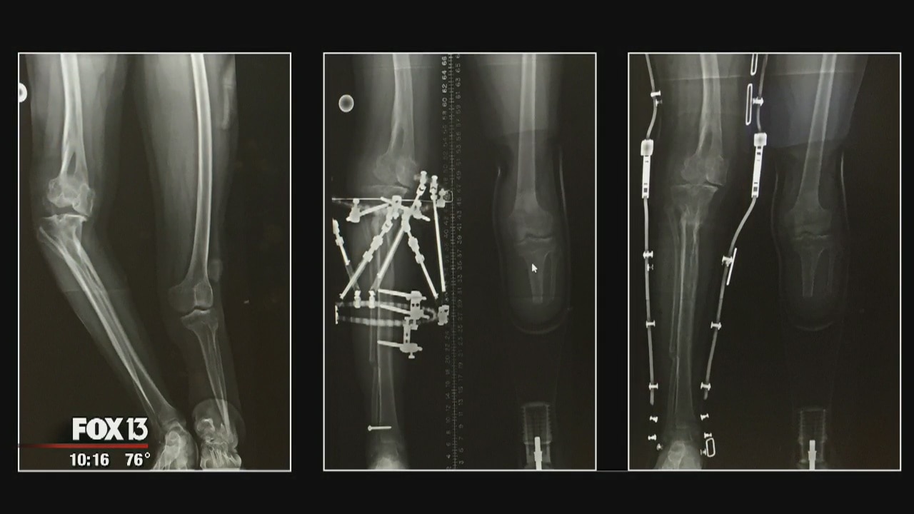 Palestinian teen shows off new legs after surgery