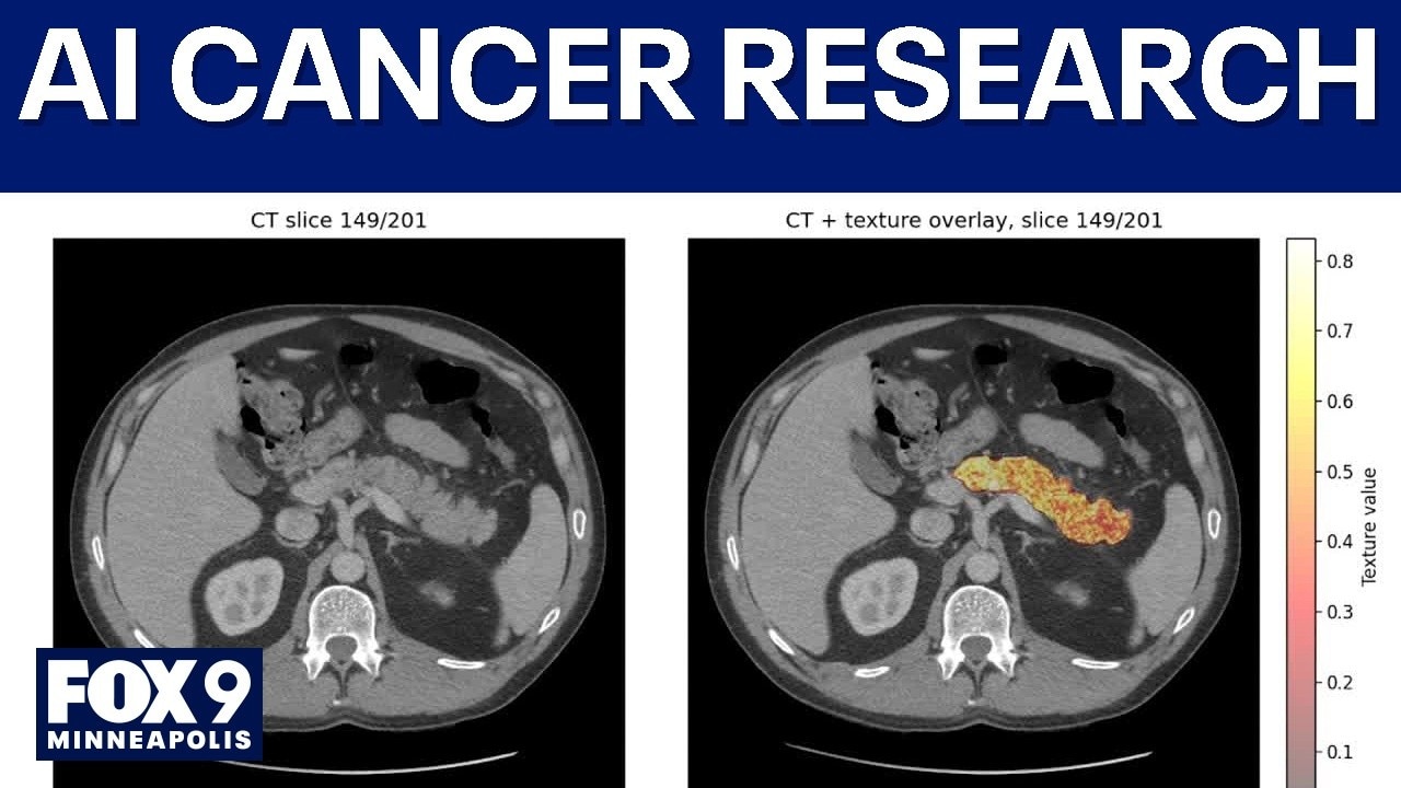 Mayo Clinic AI tool helps catch pancreatic cancer