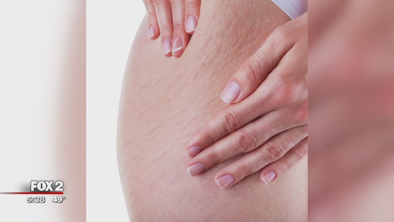 New drug may combat cellulite, local doctor looking for volunteers