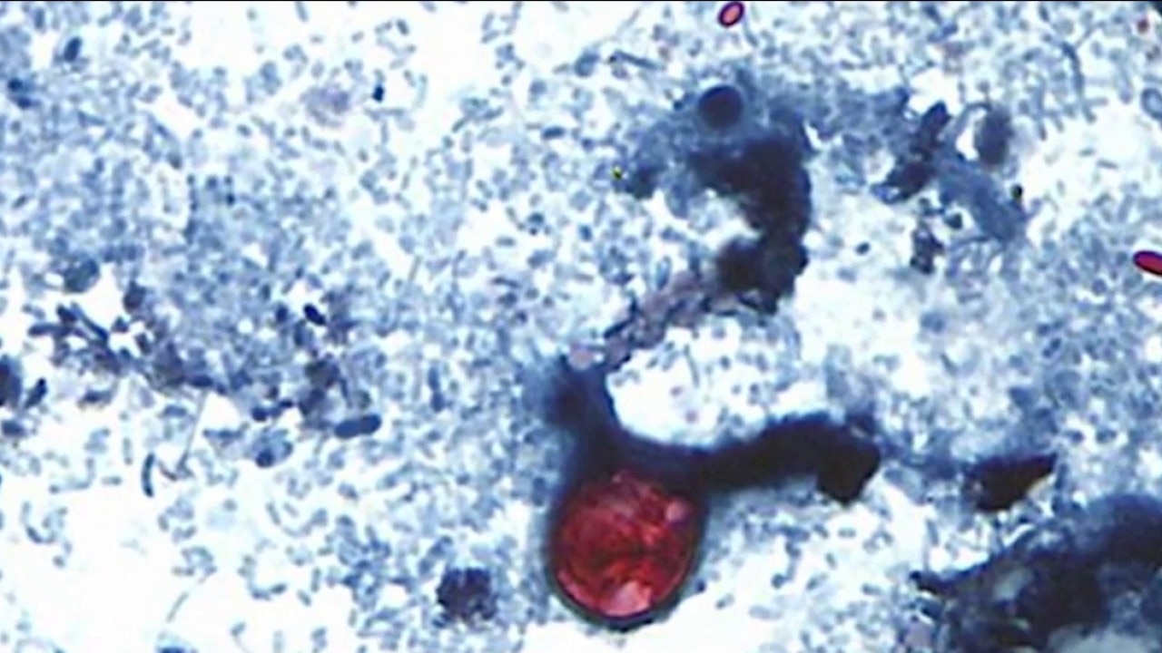 Cyclospora outbreak linked to lettuce sickens nearly 2,000 as CDC warns cases may rise