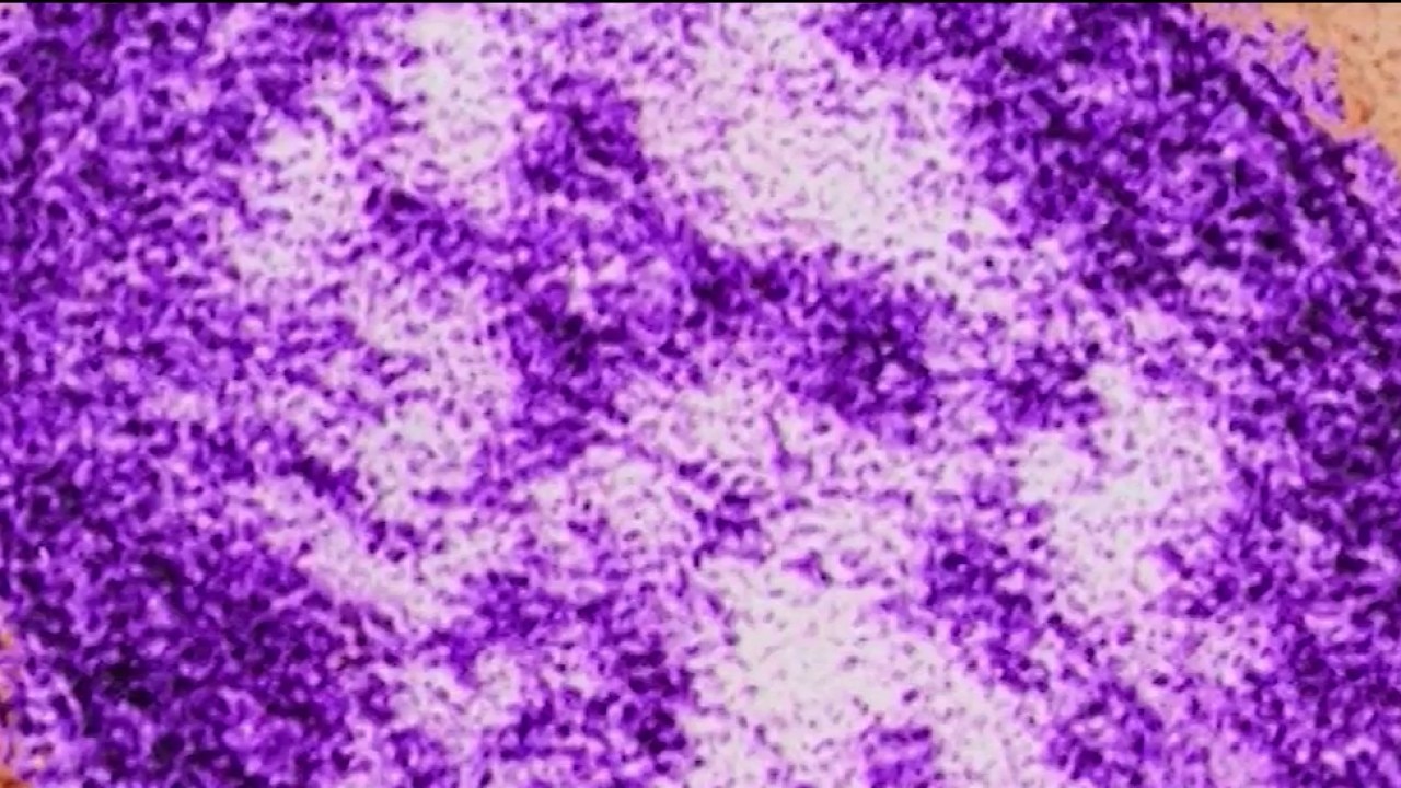 2 new measles cases linked to Atlanta daycare