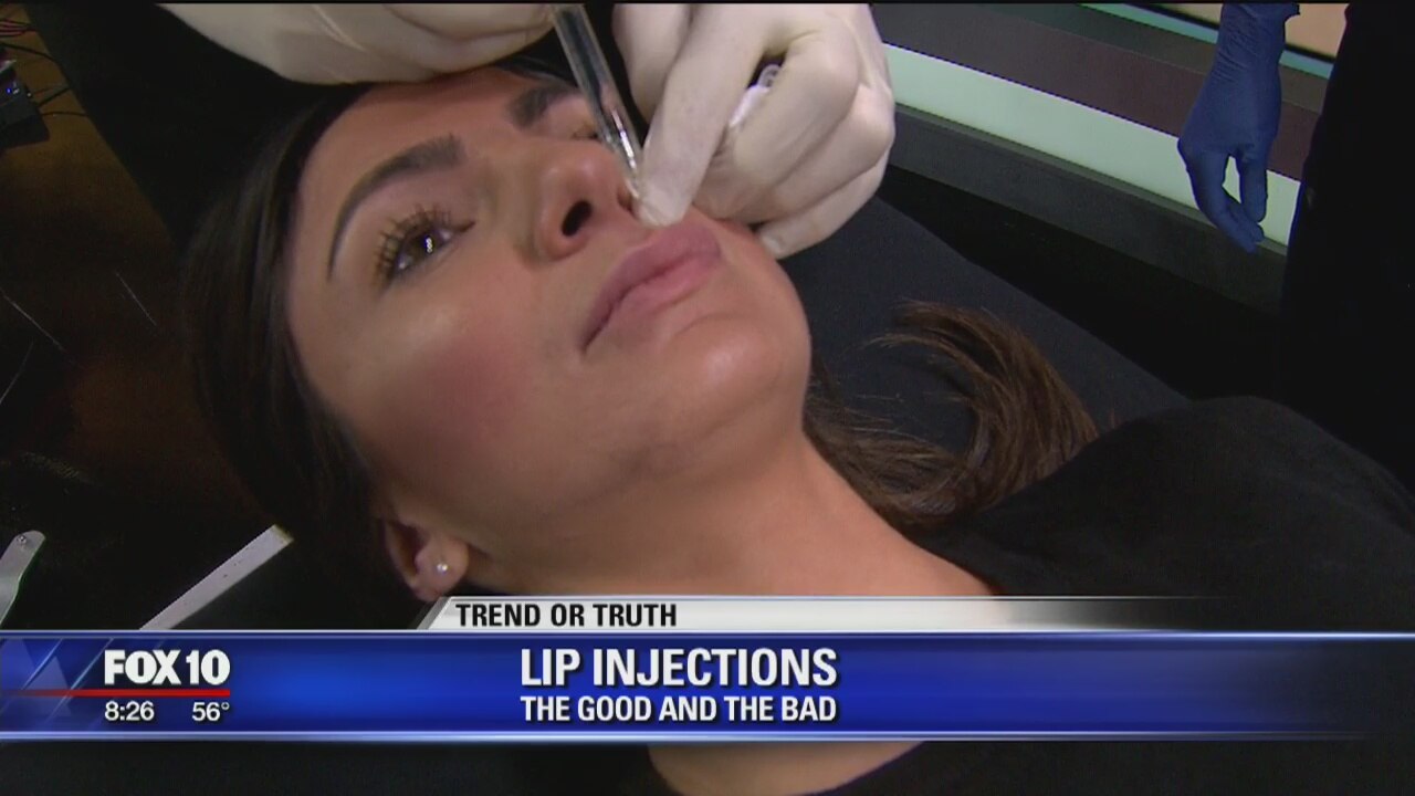 Trend or Truth: Lip injections