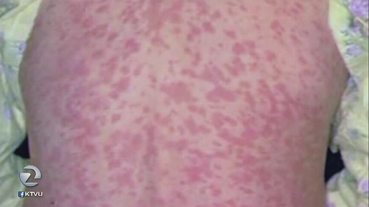2nd case of measles in Santa Clara County