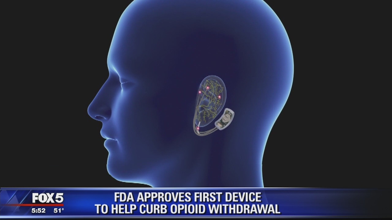 FDA clears nerve stimulator to aid recovery from opioids
