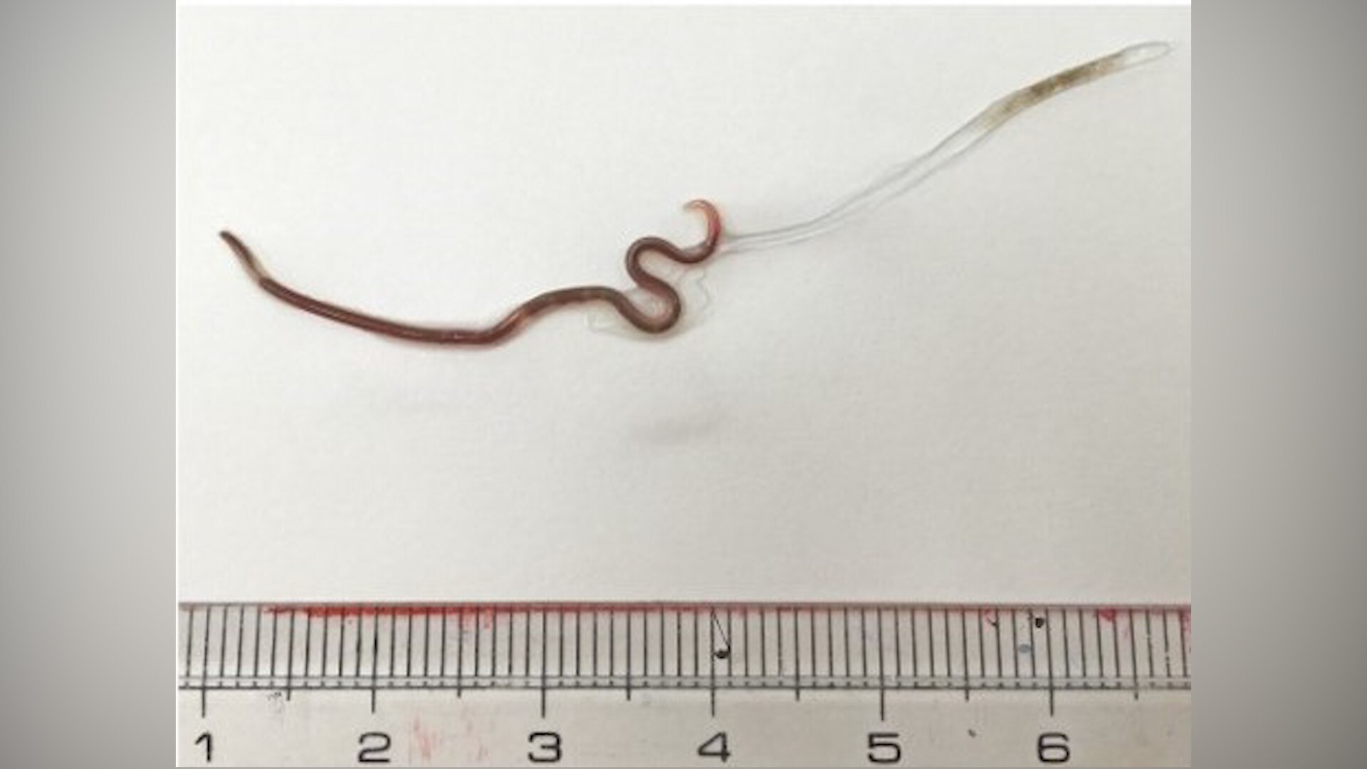 Parasite inside woman tonsil after consuming raw fish