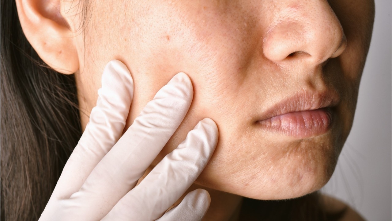 Dermatologist provides tips to avoid ?maskne? ? mask-related acne