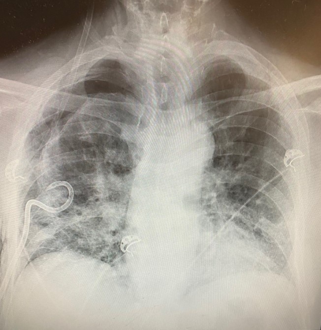 Texas surgeon noticing some post-COVID-19 lungs have more scar tissue than smokers? lungs