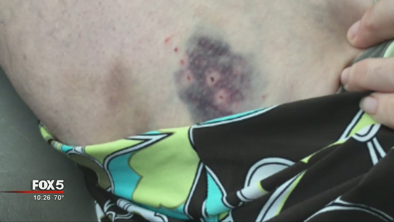 Woman attacked by shark on vacation