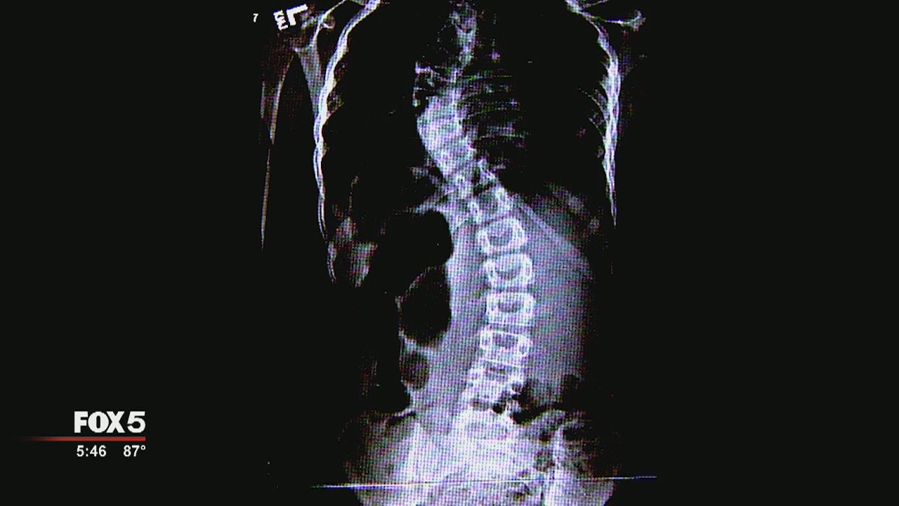Magnetic rods help young scoliosis patient avoid surgery