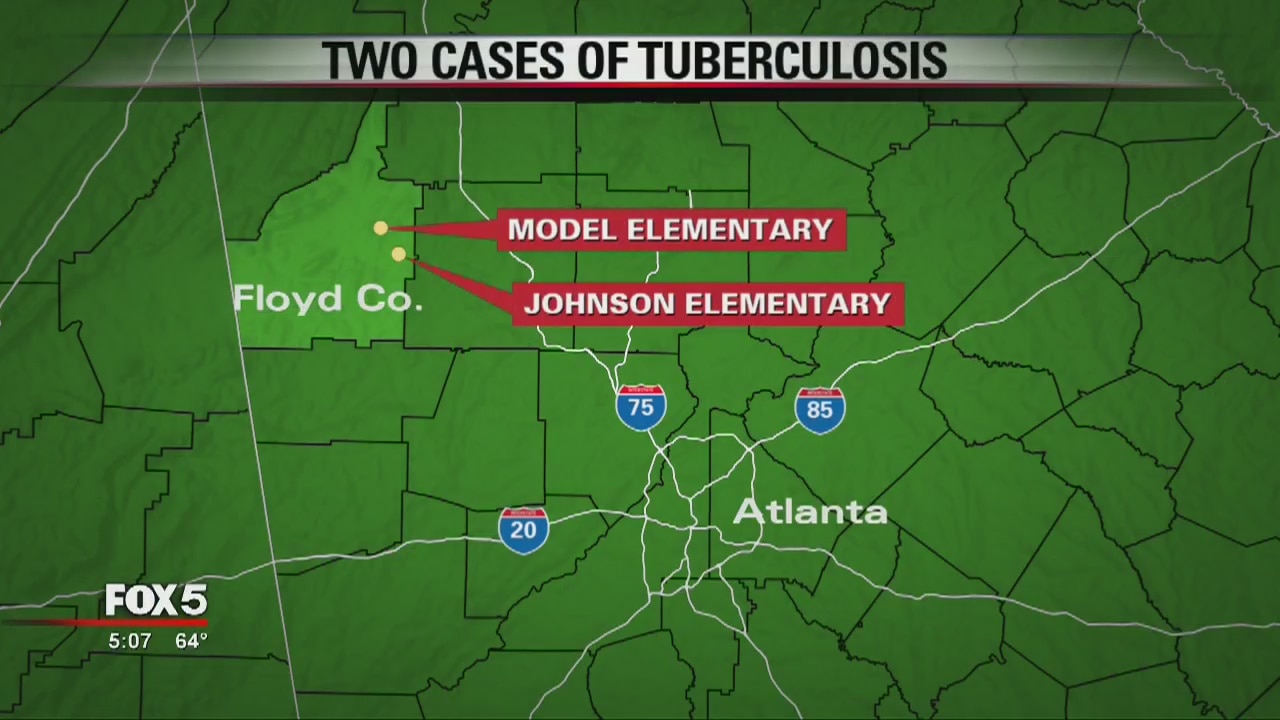 Two cases of TB in Floyd County