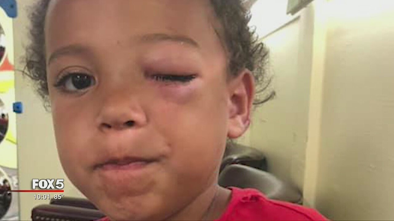 Boy kicked in the eye on school bus