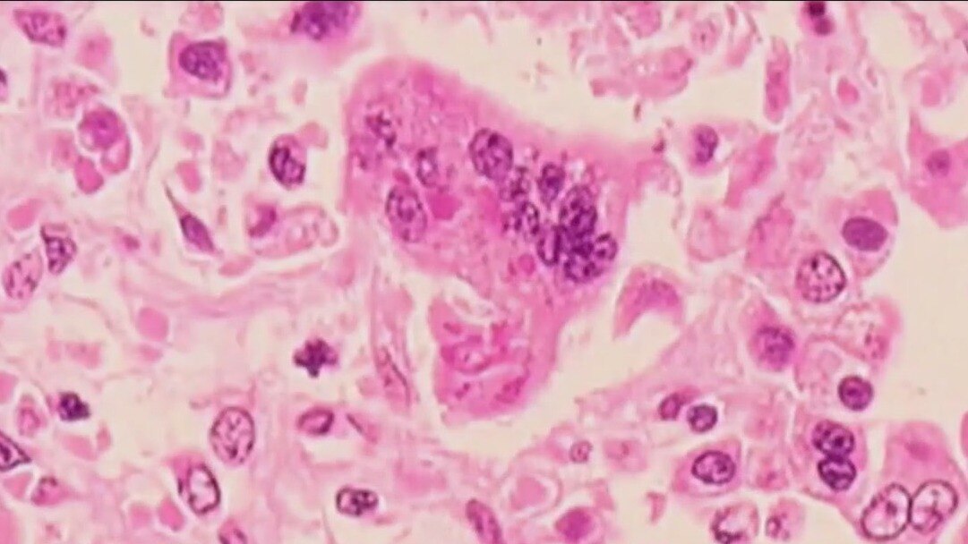 Measles cases increase as vaccination rates decrease