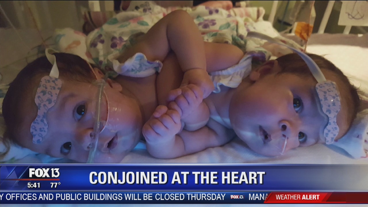 UF doctors separate twins conjoined at heart