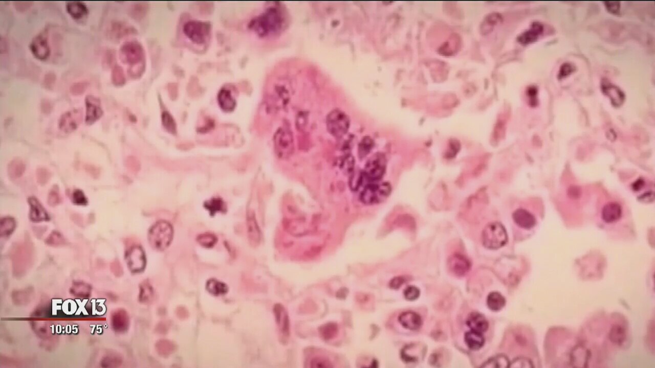 DOH: Two additional measles cases reported