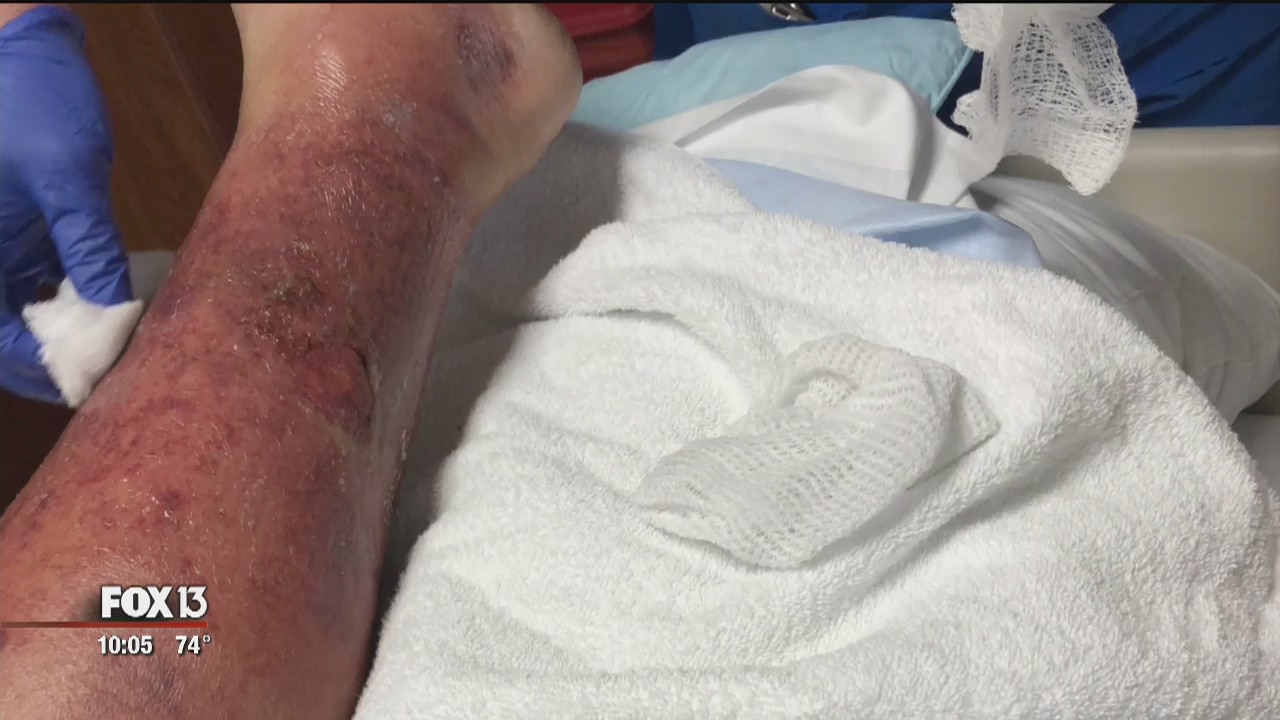 Man contracts vibrio vulnificus infection