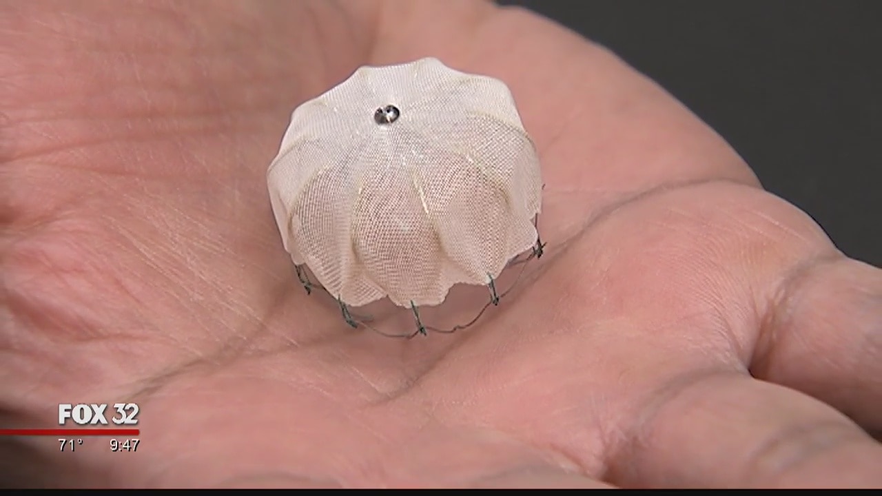 New implantable device could prevent strokes