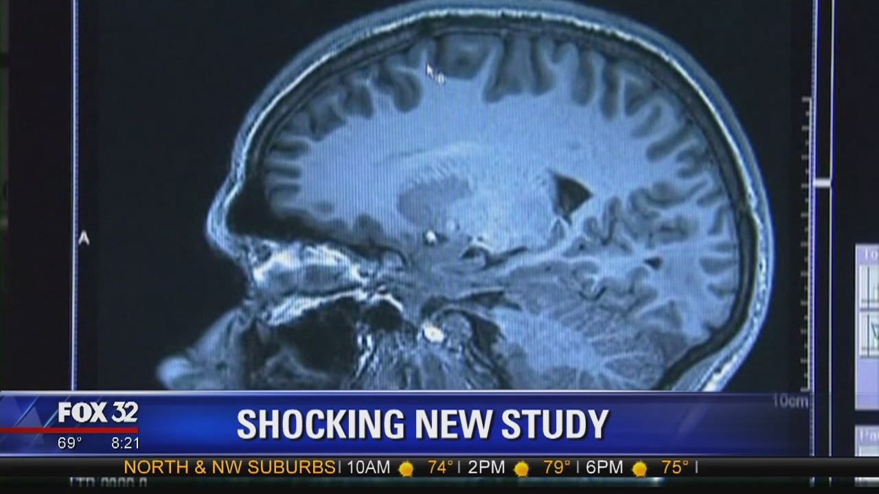 Concussions and Brain Trauma