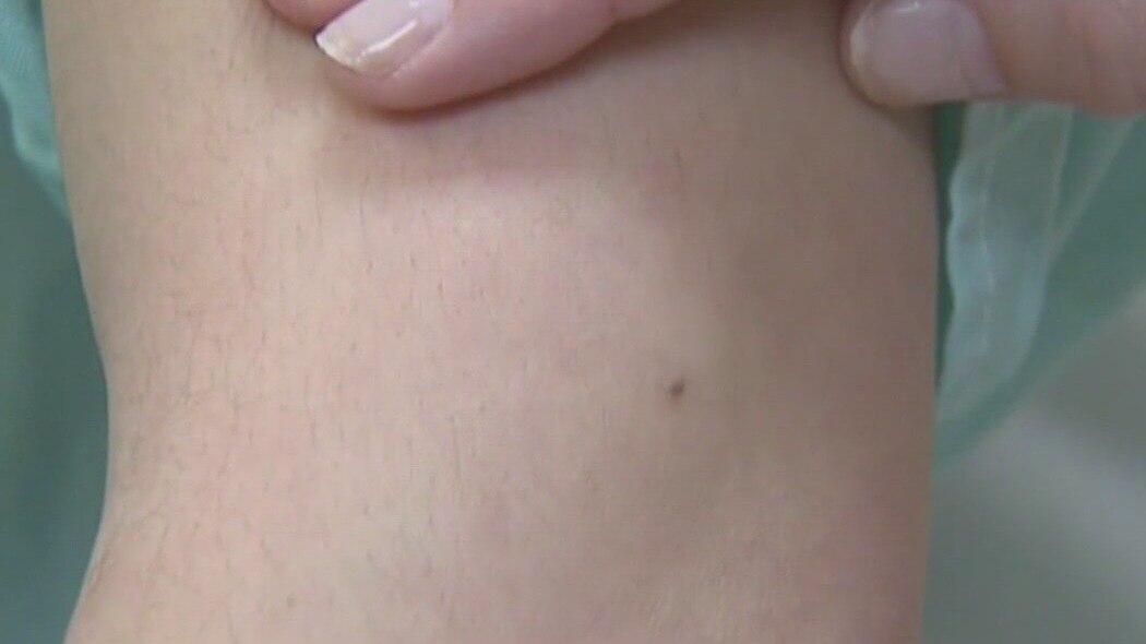 Regular exams encouraged to prevent melanoma