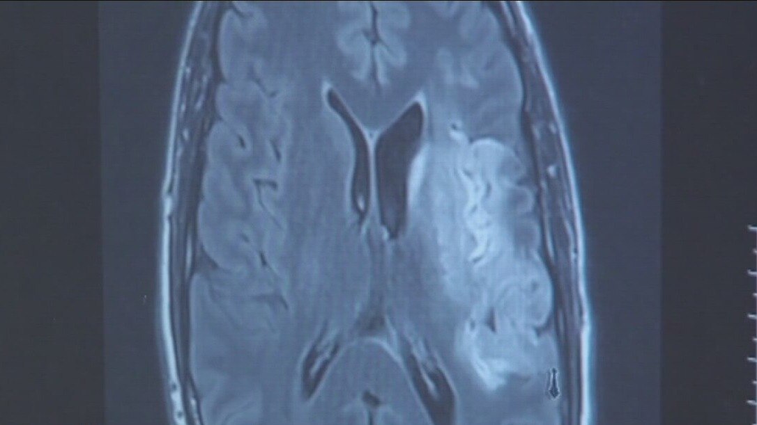 Stroke Awareness Month: Knowing the signs