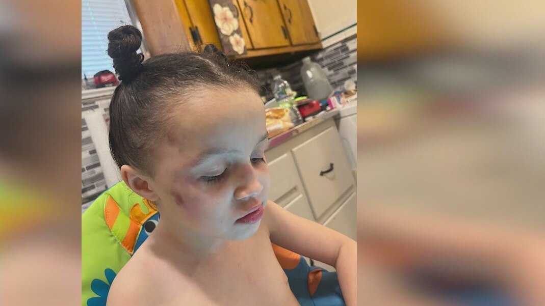 Questions after 4-year-old girl apparently bruised on school bus