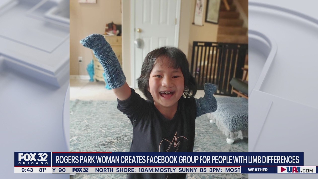 Rogers Park woman creates Facebook group for people with limb differences