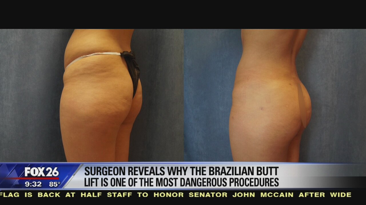 Surgeon reveals why Brazilian Butt Lift is dangerous