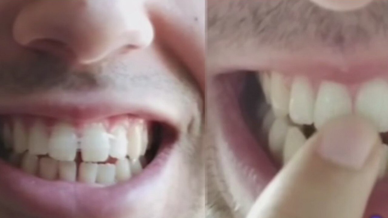 Don't do it: Why at-home braces are a bad idea