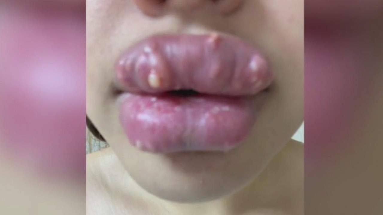 Millions of Americans are getting Botox injections, which can cause permanent damage