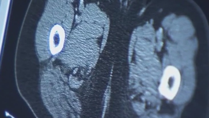 What causes lung cancer in nonsmokers?