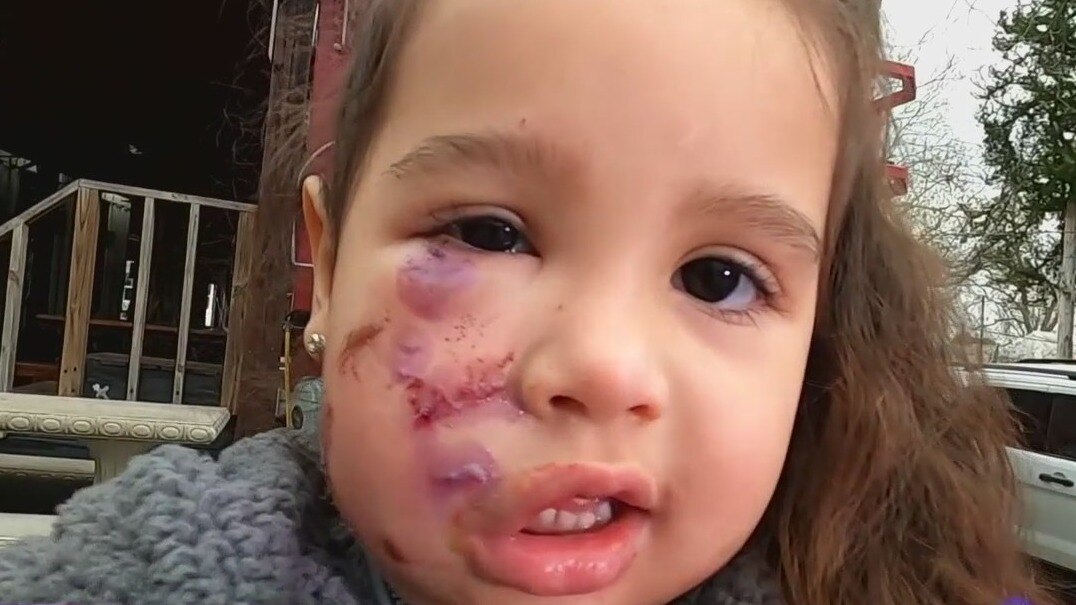 Mother of 3-year-old girl mauled by dog speaks out