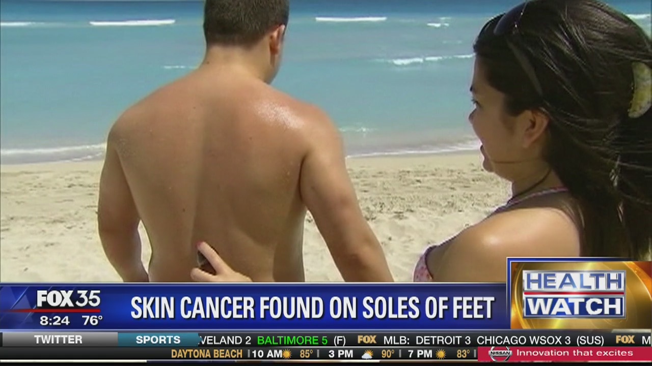 Skin cancer found on soles of feet