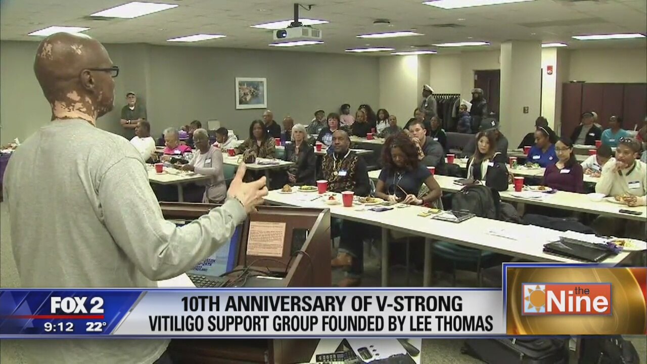 Lee Thomas's vitiligo support group celebrates 10 years