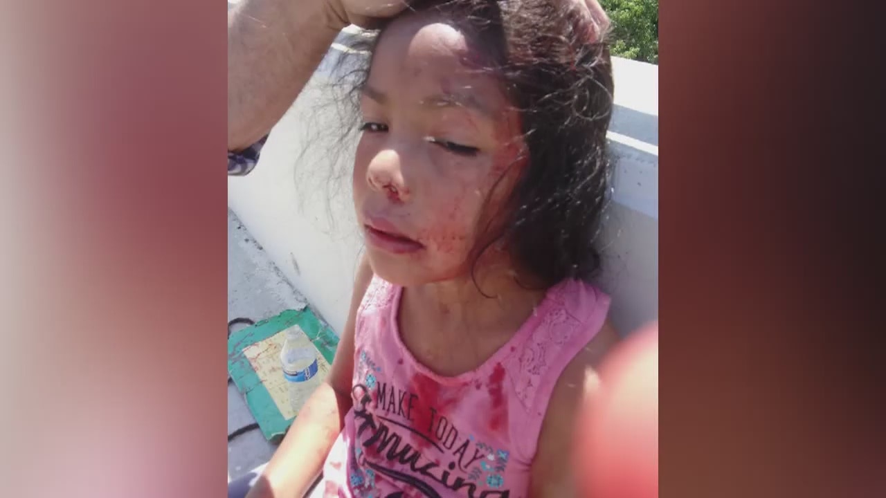 5-year-old girl suffers major injuries