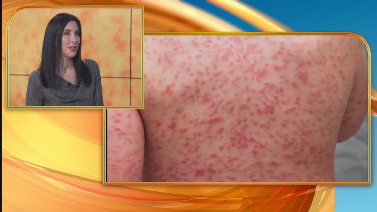 Kawasaki disease: Dr. Lauren Crosby discusses symptoms and treatment