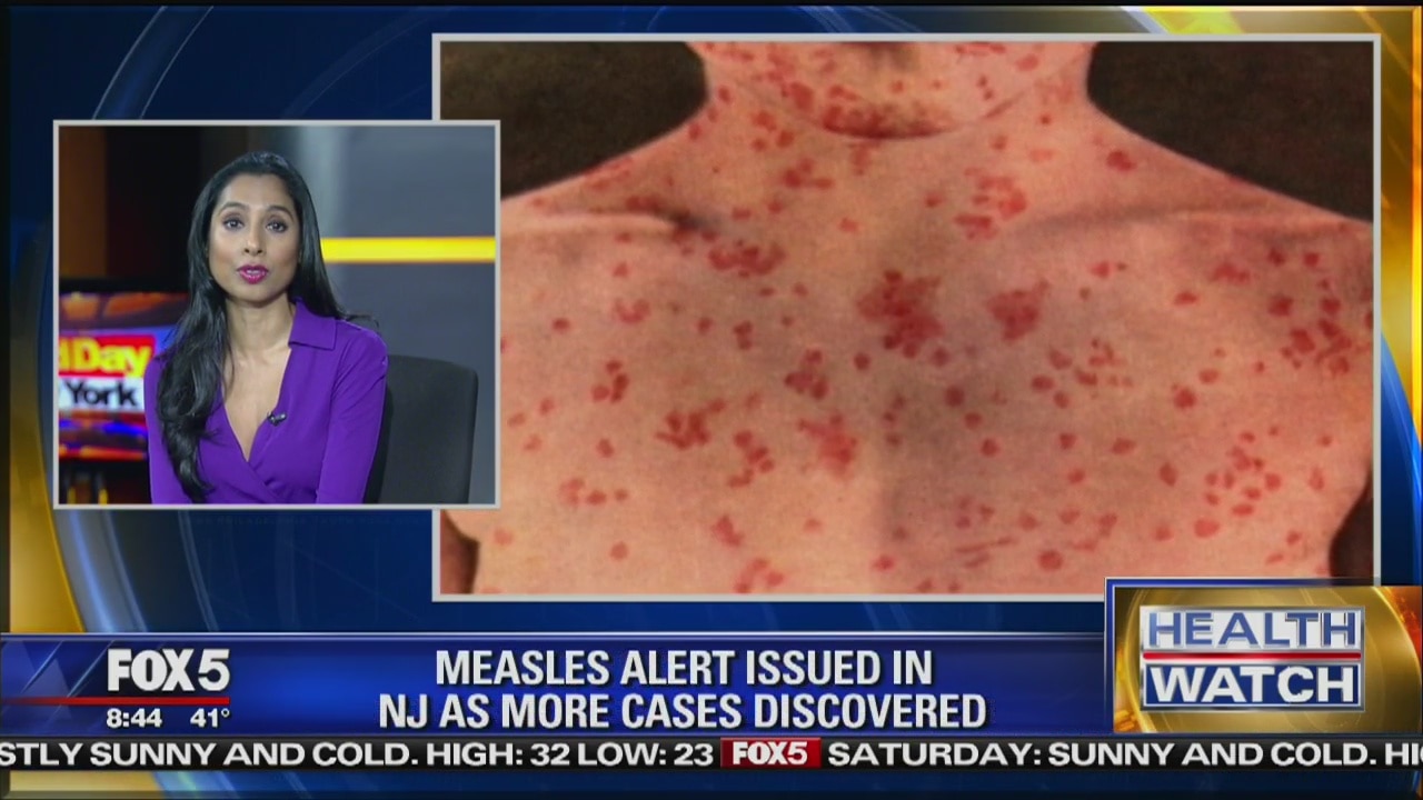 Measles Alert in NJ