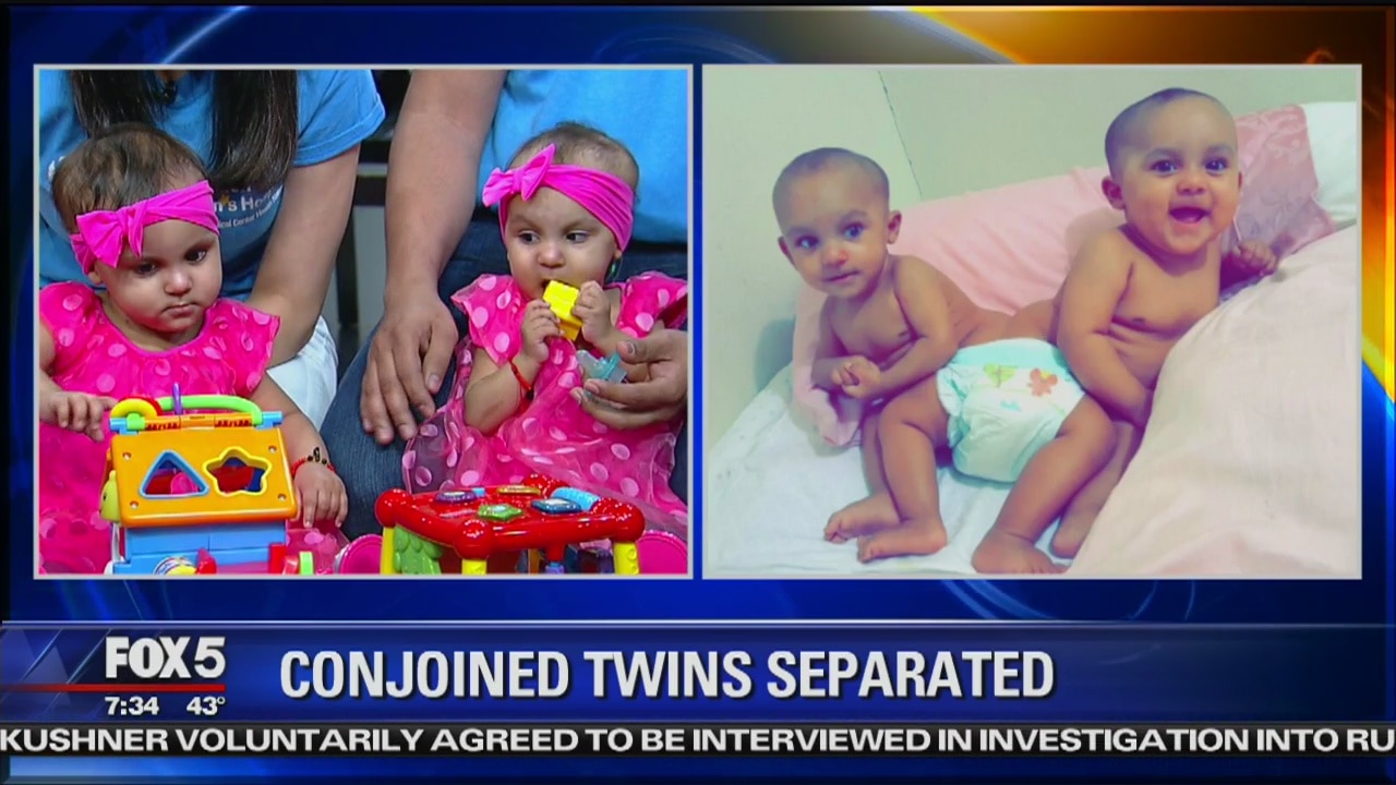 Formerly conjoined twins thriving