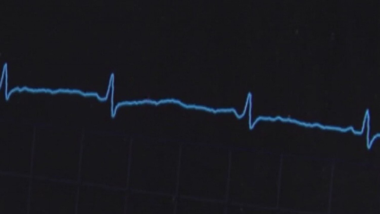 Cardiac arrests and silent heart attacks