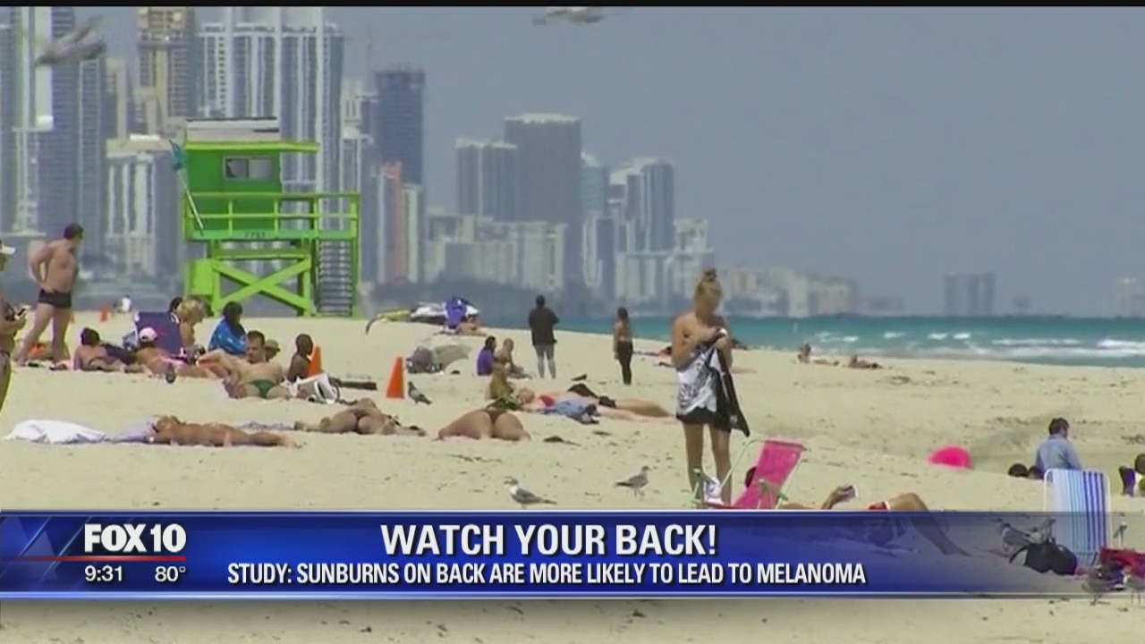 Study: sunburns on back likely to lead to melanoma