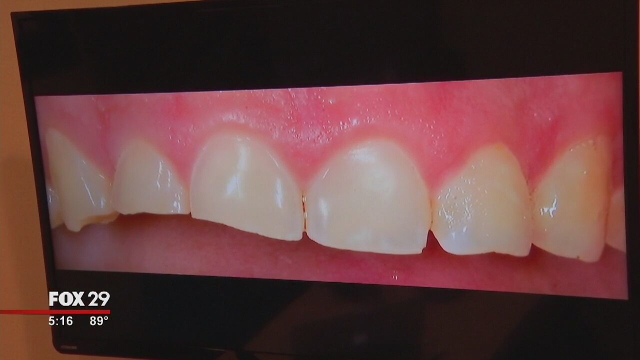 Are fizzy drinks harmful for your teeth?