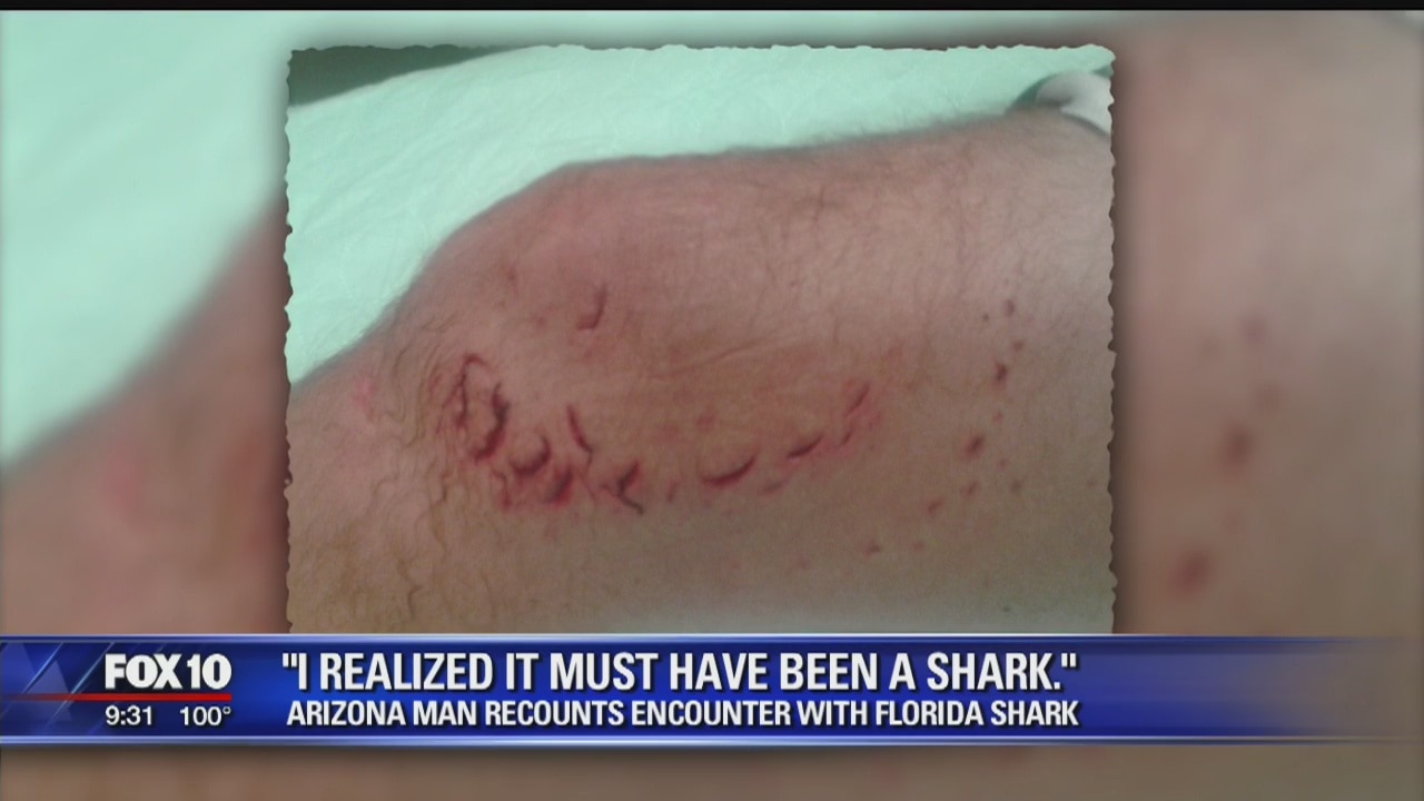Arizona shark attack victim talks about ordeal