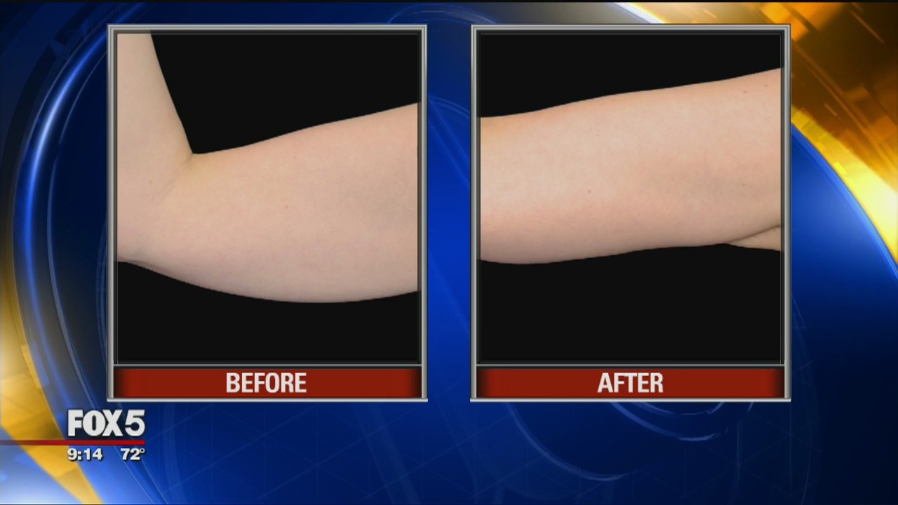 Battling 'bat wings'