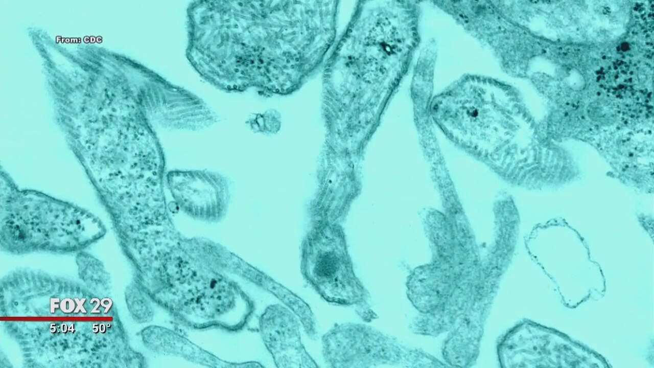 Number of Temple University mumps cases grows to 86
