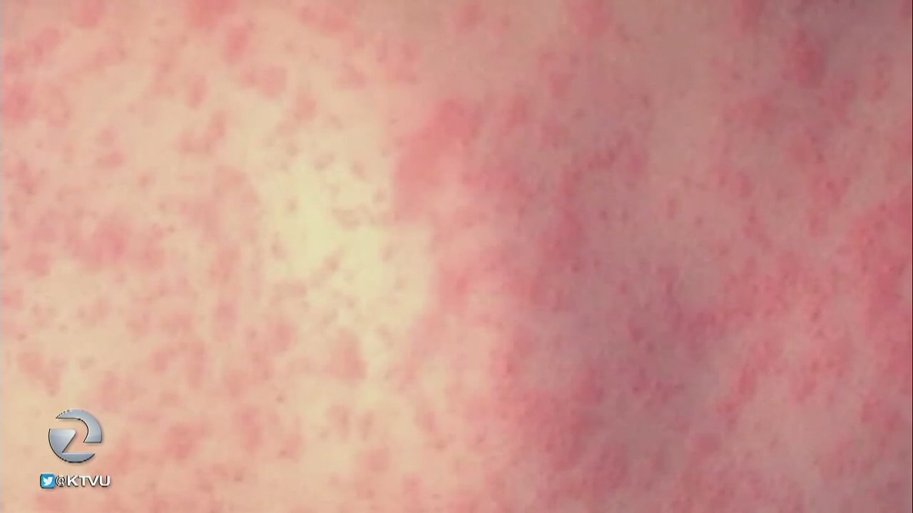 3 cases of measles in Bay Area