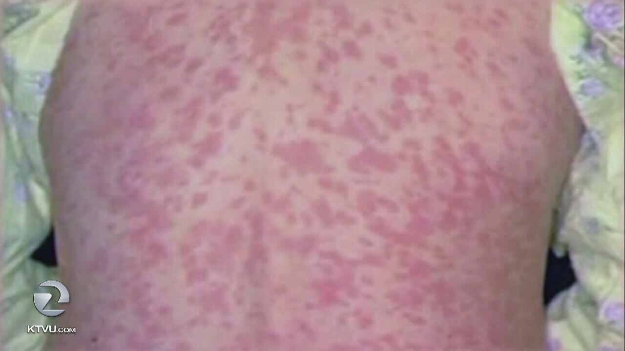 Measles in Santa Clara County