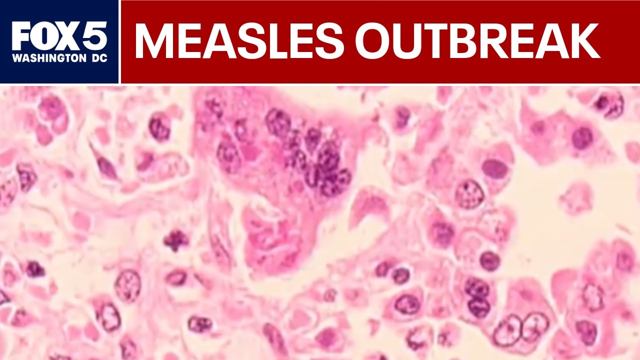Measles outbreak declared in 3 Maryland counties